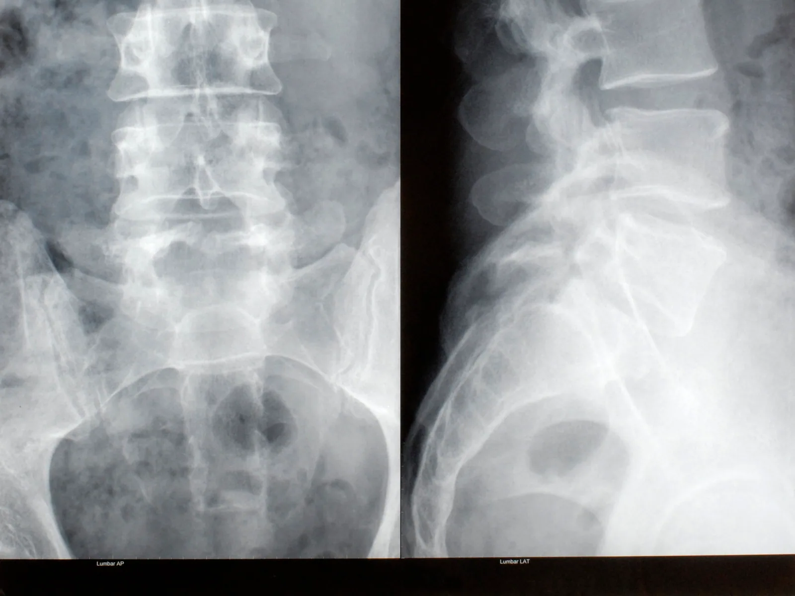 Radiografia da coluna vertebral